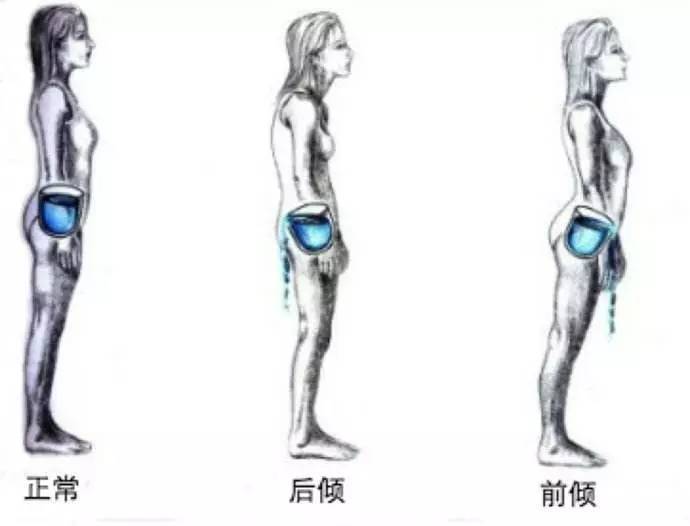 骨盆前倾原因_髋关节训练椅_骨盆前倾改善方法