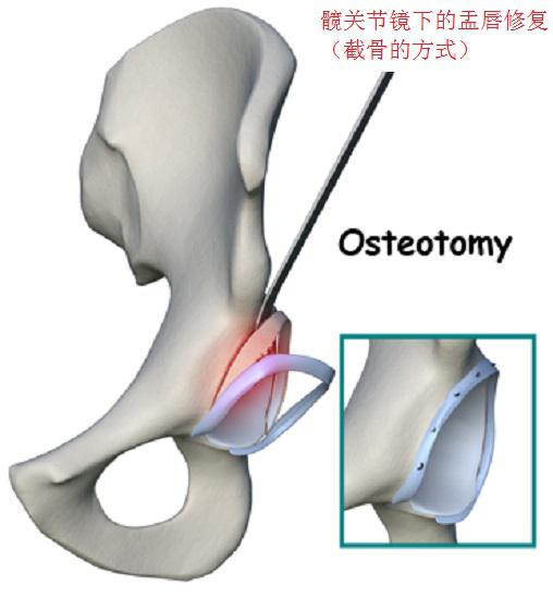 髋关节镜下的盂唇修复