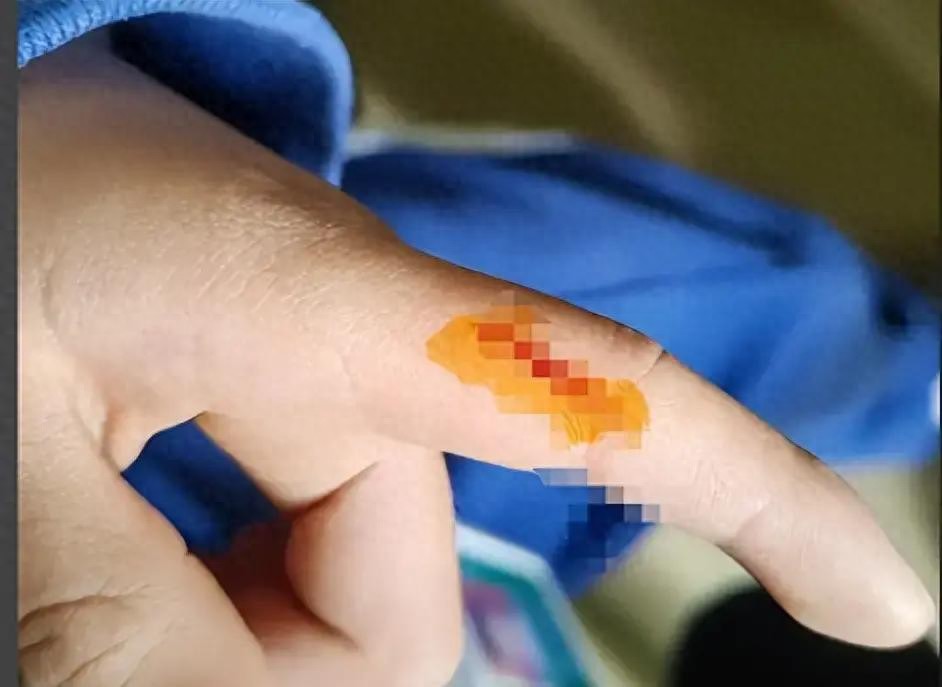 汗汗画画免费阅读在线阅读下拉式 一定要戴手套！43岁男子8天离世，死亡率近100%：你我都在