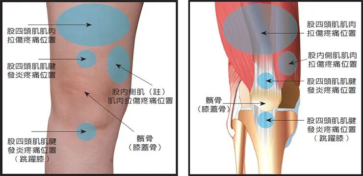 股四头肌训练椅_股四头肌肌腱撕裂症状_股四头肌肌腱解剖