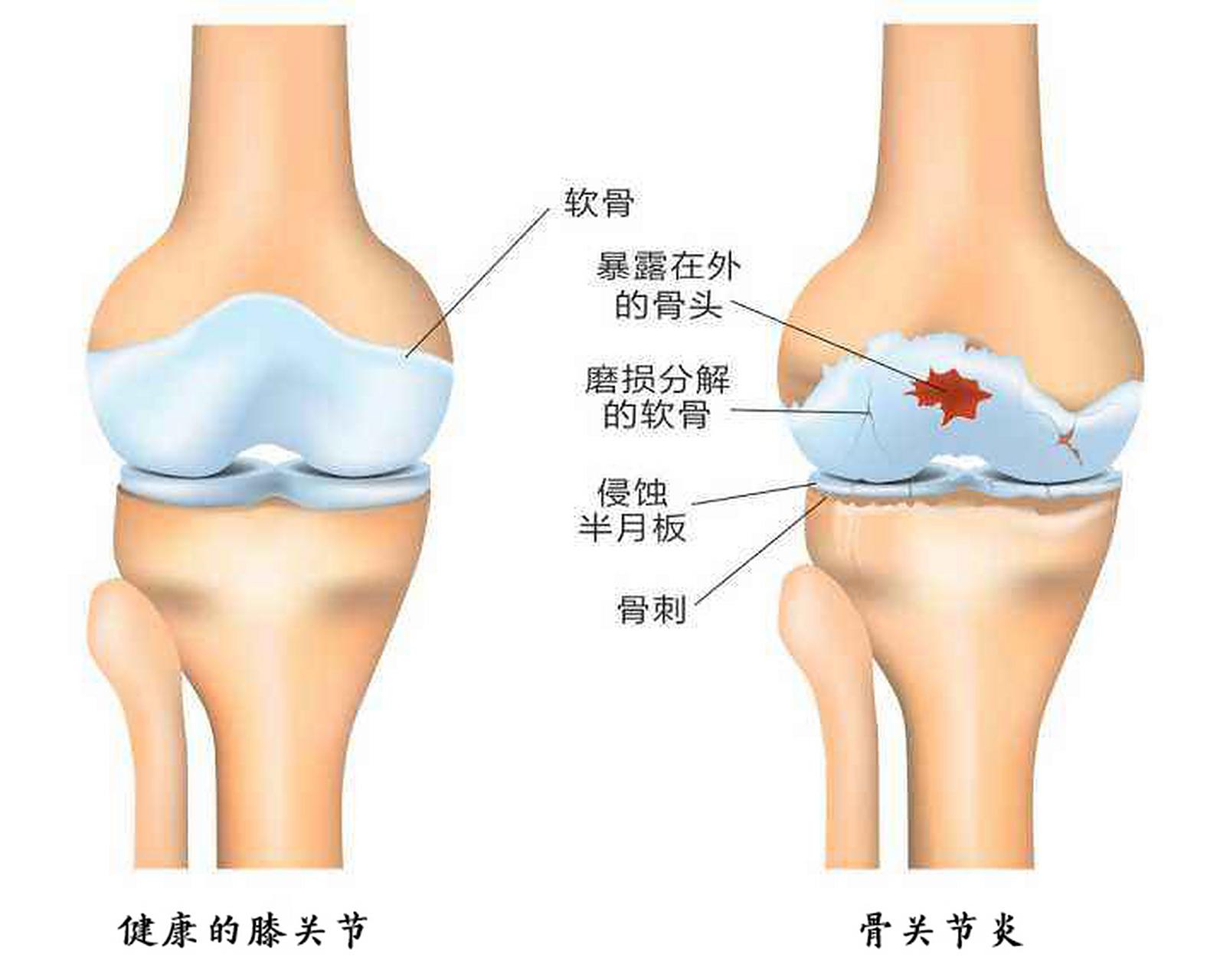 膝盖疼痛_股四头肌训练椅_膝盖保养